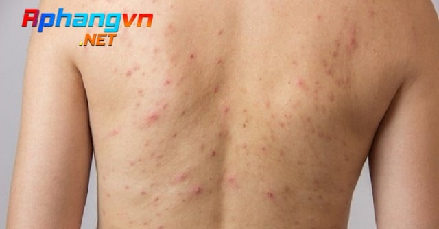 cach-tri-mun-lung-1.jpg